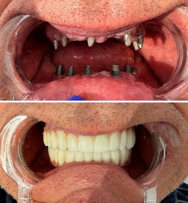 Impianti Dentali